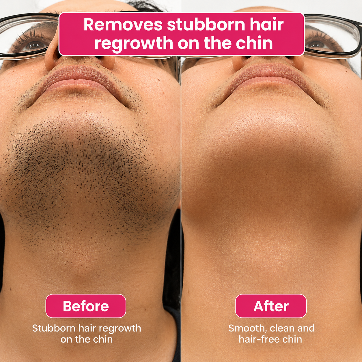 🔥LAST DAY 60% OFF Soulhera Hair Reduction Oil 60 ml – Permanent Hair Removal Oil
