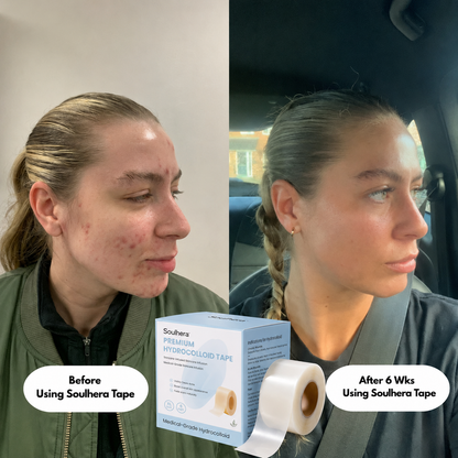 SOULHERA Premium Hydrocolloid Roll That Heals & Protects Your Skin
