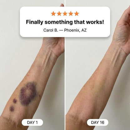 💥100K+ SOLD💕- SOULHERA® Bruise Repair & Skin-Strengthening Cream